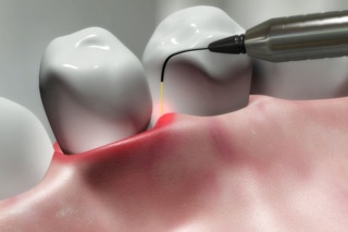 Laser Dentistry