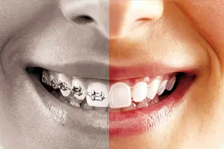 Orthodontics & Invisalign