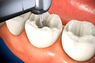 Root Canal Therapy