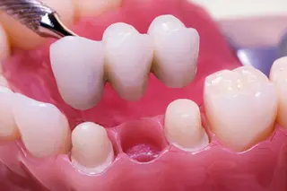 Crowns, Bridges & Veneers