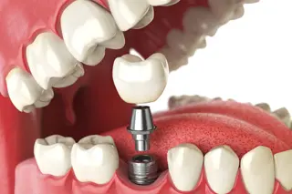Implant Dentistry