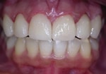 Teeth After Veneer