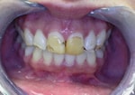 Teeth Before Veneer