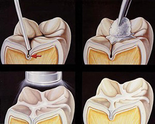 complete process Dental Sealant