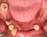 Before Dental Implant Bridge