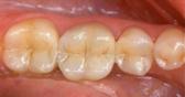 Repaired teeth with crowns
