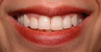 Teeth After Veneer