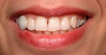 Teeth Before Veneer