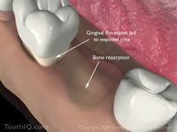 Bone Grafting