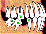 Shifting teeth