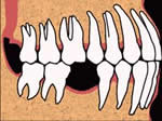 Loss of a single tooth