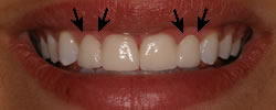 After Laser Gum Recontouring