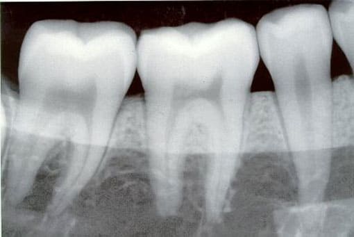 Teeth X-ray photo