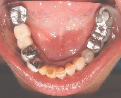 Dental Implant Process Before
