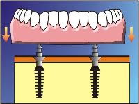 Dental Implant Bridge