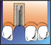 Dental Implant Process Step 1