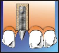 Dental Implant Process Step 2