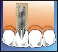 Dental Implant Process Complete