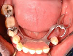 Dental Implant Bridge placing supports