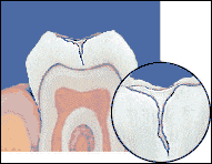 Cracked tooth