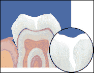 Cracked tooth repaired with Sealant